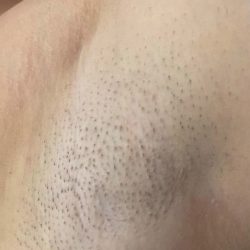 Laser hair remove procedure BEFORE